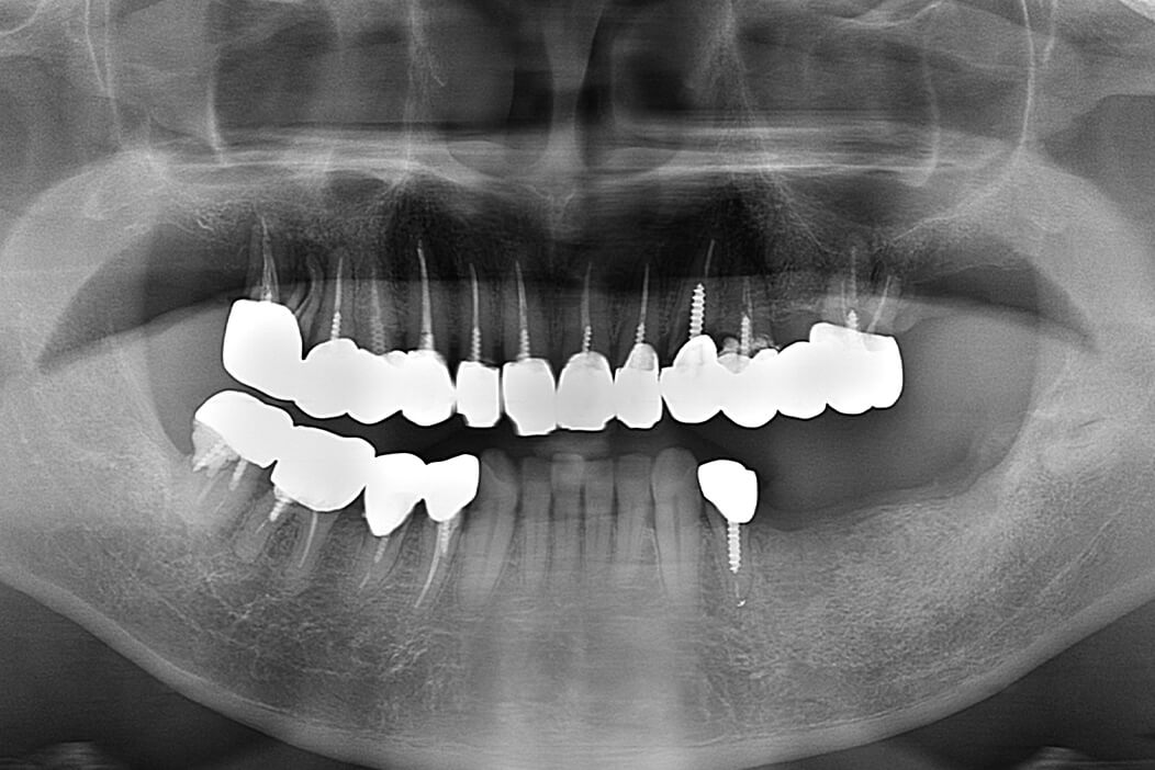 下顎左側臼歯部の欠損部にインプラント治療を行なった症例