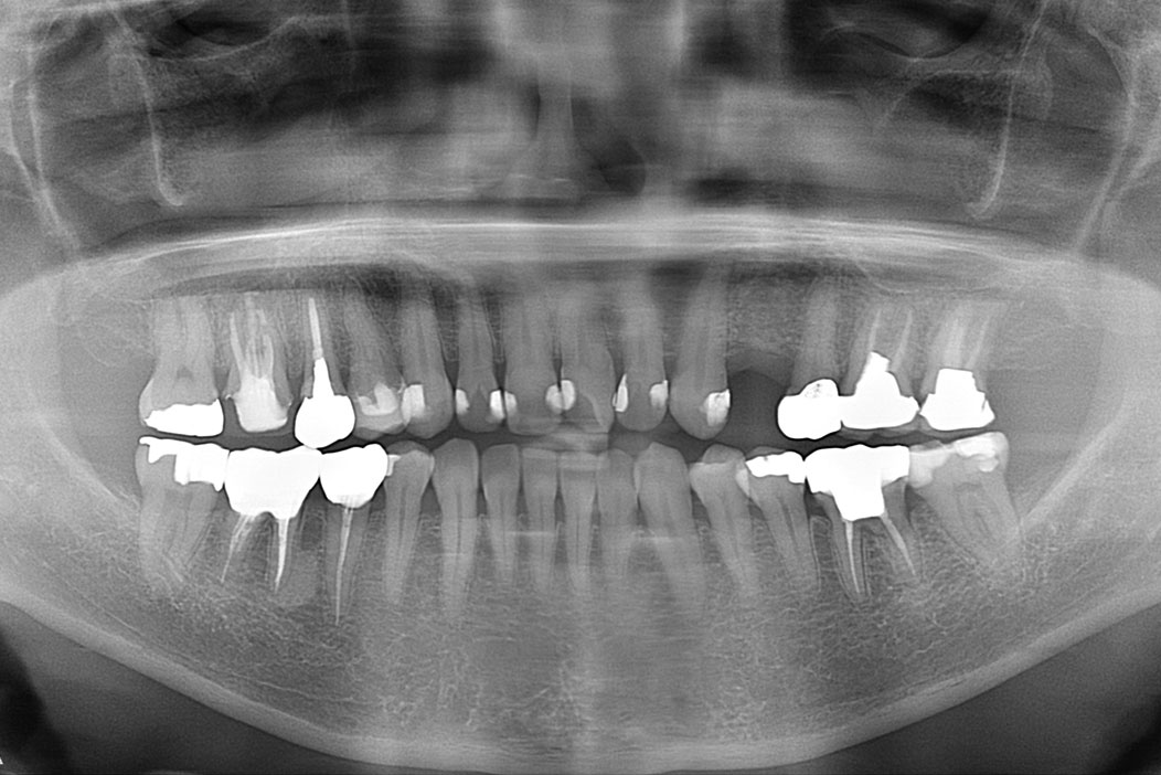 上顎左側第一小臼歯にフラップレスインプラント手術で即時修復治療を行なった症例