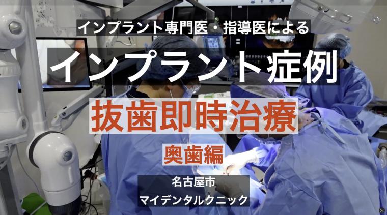 YouTube 症例動画第二弾！抜歯即時〜奥歯編〜