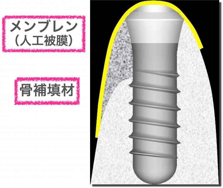 GBRって何？