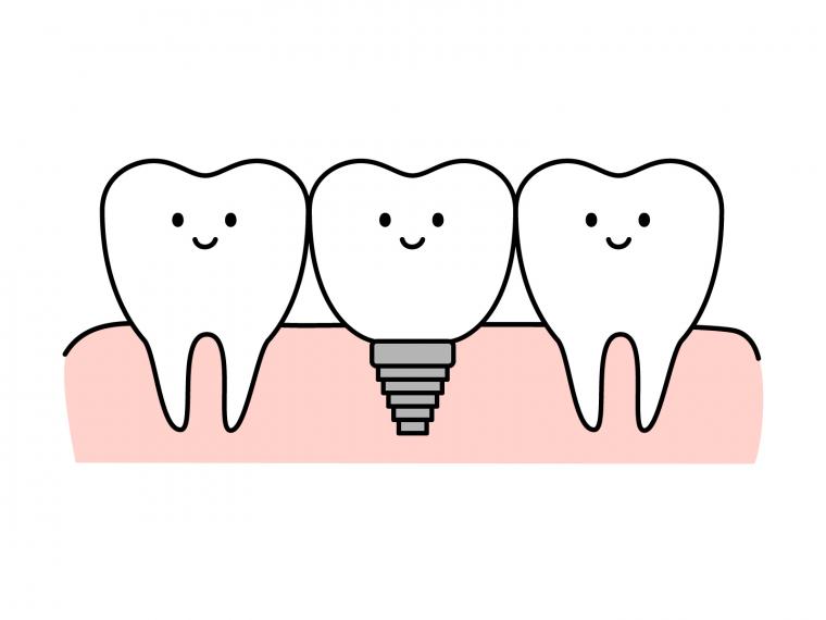 インプラントは周りの歯と歯ぐきを守ってくれてます！