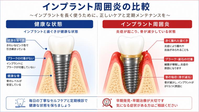 インプラント周囲炎とは？ ～インプラントを長持ちさせるために知っておきたい大切な病気～