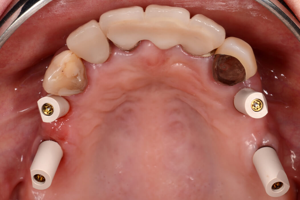 上顎両側臼歯部に抜歯即時インプラントと即時荷重治療を行なった症例