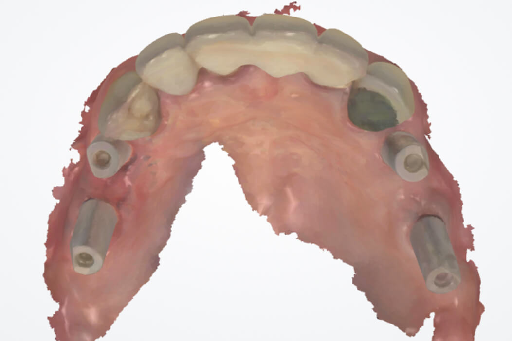 上顎両側臼歯部に抜歯即時インプラントと即時荷重治療を行なった症例