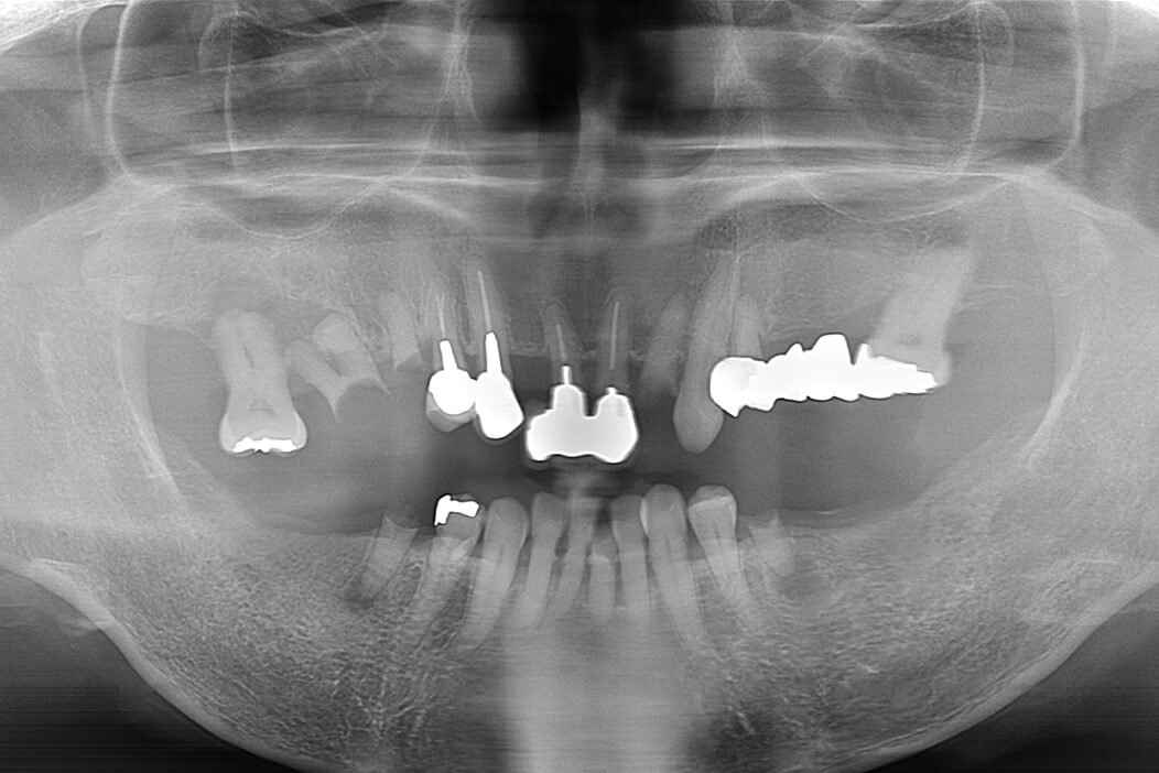 歯科治療が苦手な患者様が全体的に頑張って治療を行なった症例