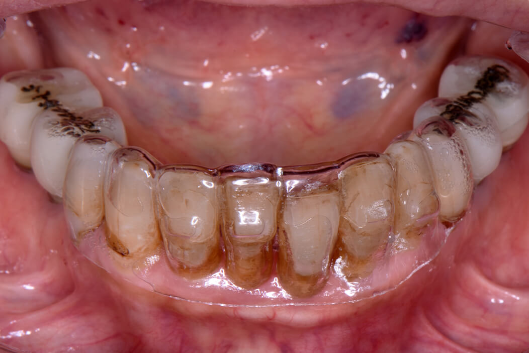 歯科治療が苦手な患者様が全体的に頑張って治療を行なった症例