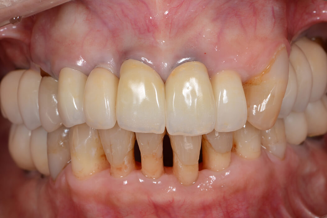 歯科治療が苦手な患者様が全体的に頑張って治療を行なった症例
