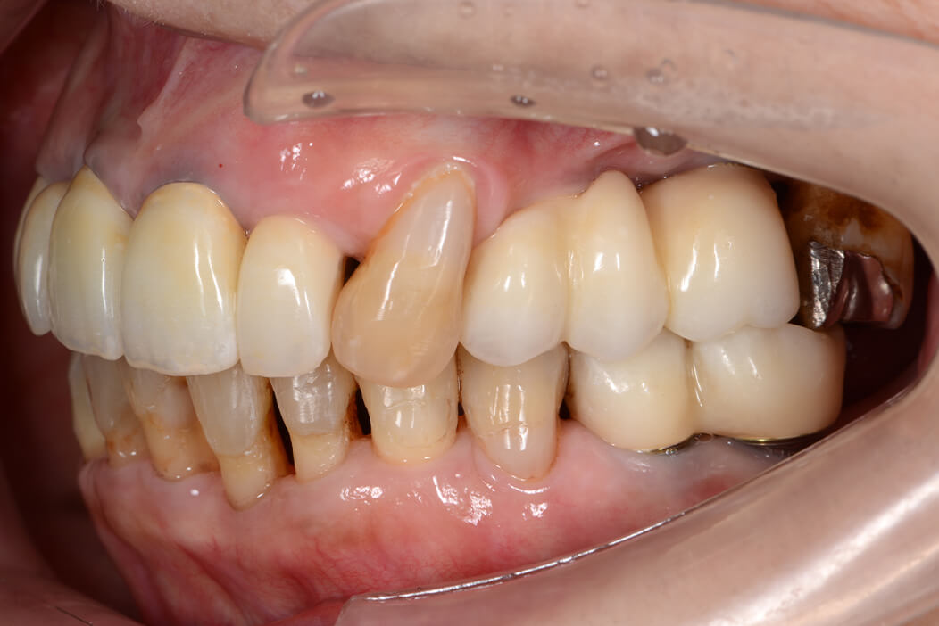 歯科治療が苦手な患者様が全体的に頑張って治療を行なった症例