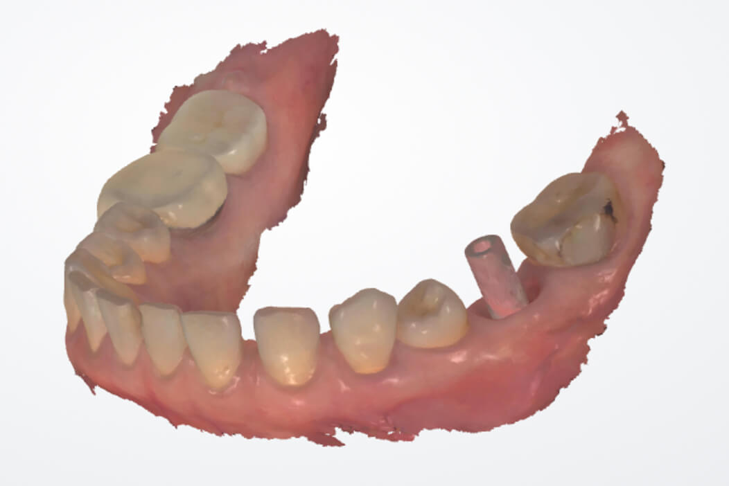 下顎左側第一大臼歯に抜歯即時インプラント治療を行なった症例