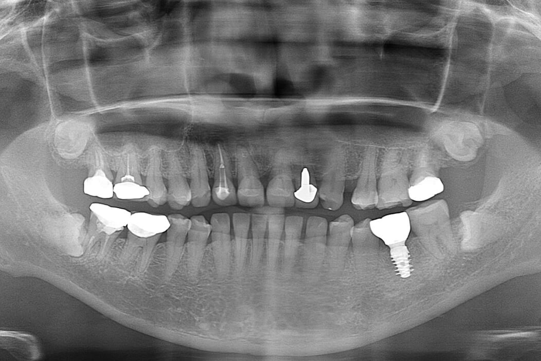 下顎左側第一大臼歯に抜歯即時インプラント治療を行なった症例