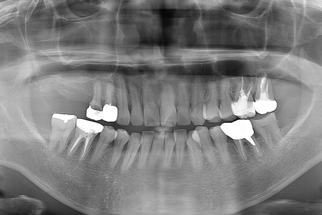 上顎右側臼歯部に抜歯即時インプラントと上顎洞挙上術（ソケットリフト）を行なった症例