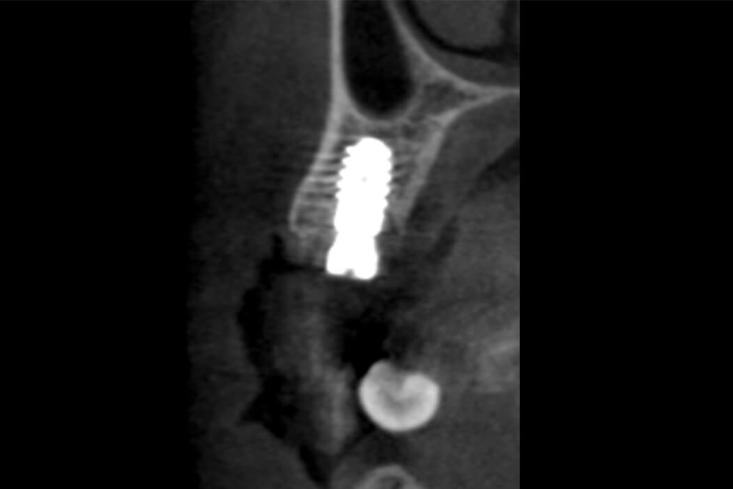 上顎右側臼歯部に抜歯即時インプラントと上顎洞挙上術（ソケットリフト）を行なった症例