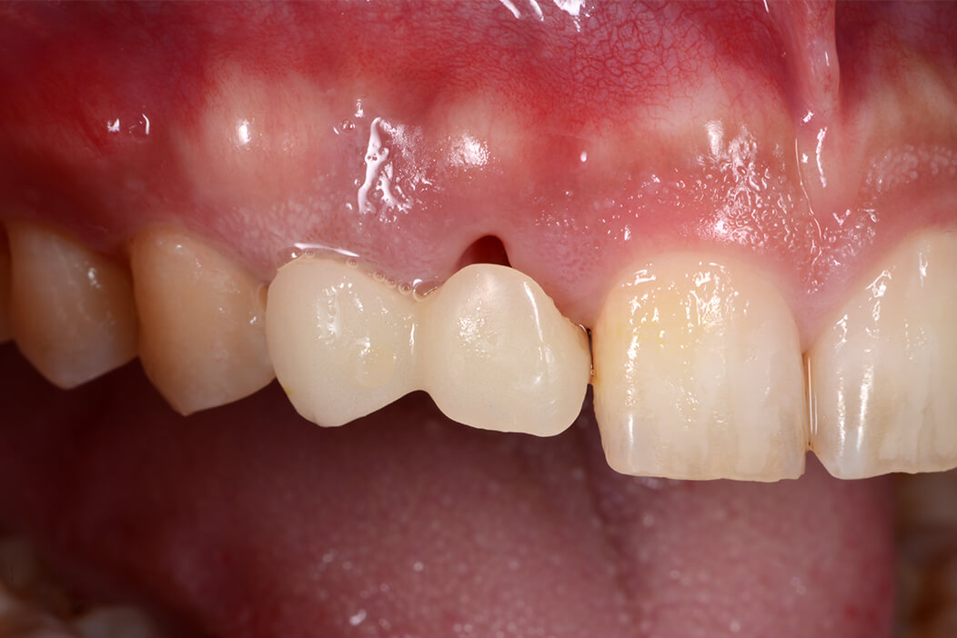 上顎右側前歯部に抜歯即時インプラント治療を行なった症例