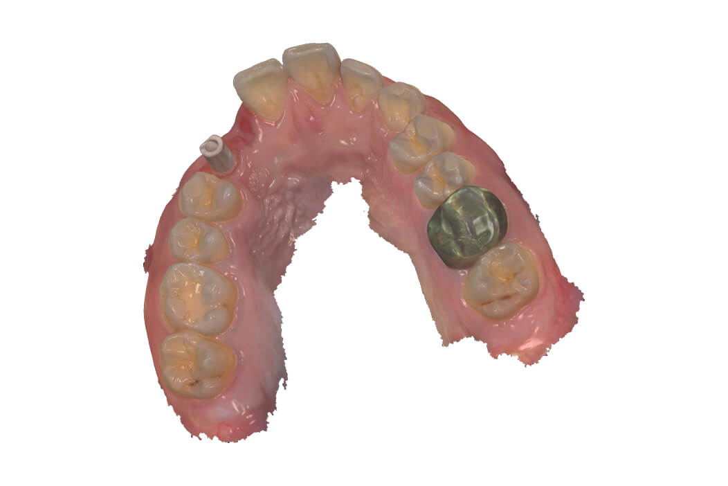 上顎右側前歯部に抜歯即時インプラント治療を行なった症例