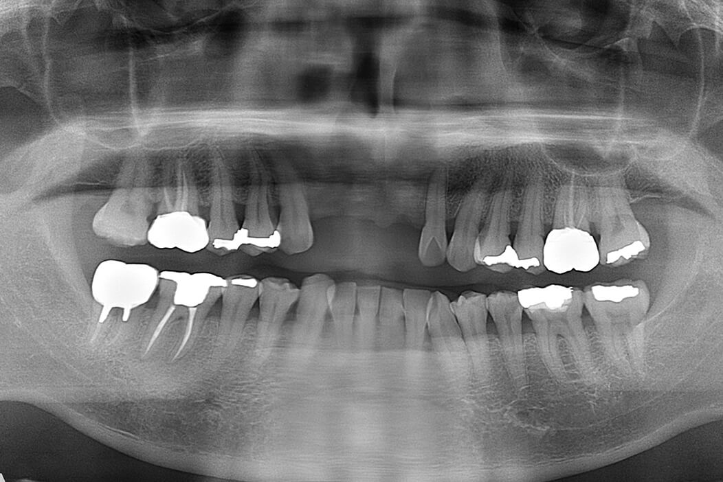 上顎前歯の欠損部にインプラント治療を行なった症例