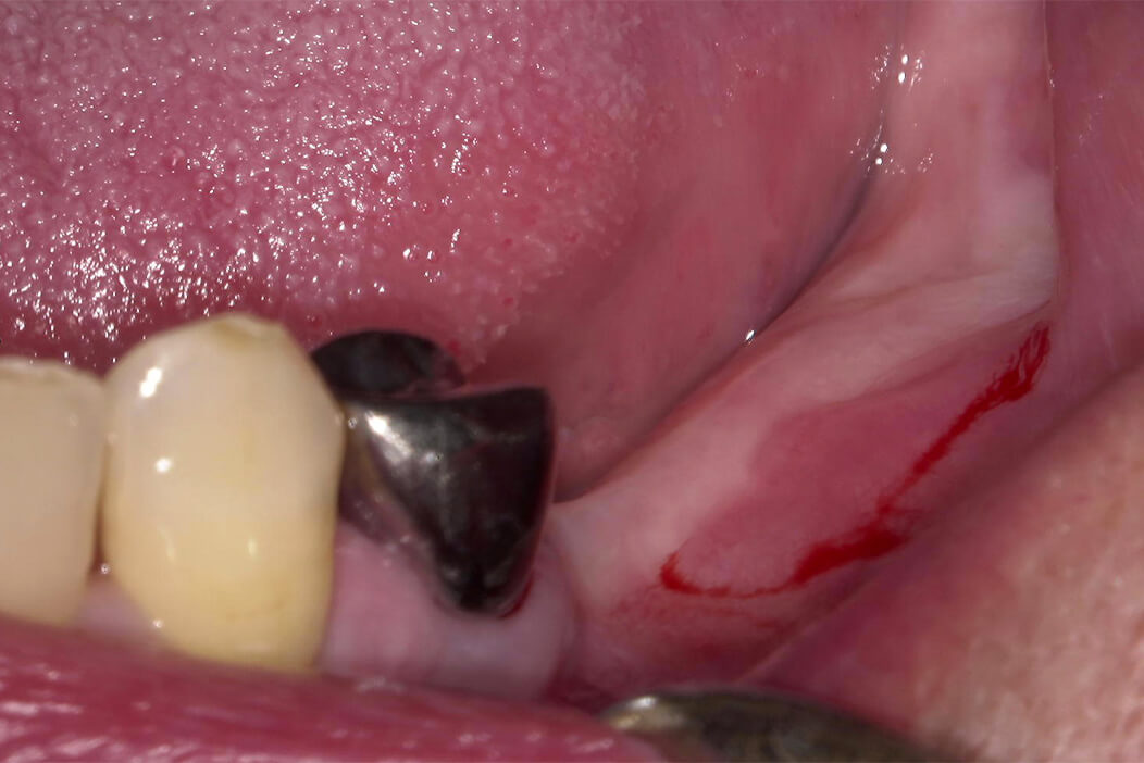 下顎左側臼歯部の欠損部にインプラント治療を行なった症例