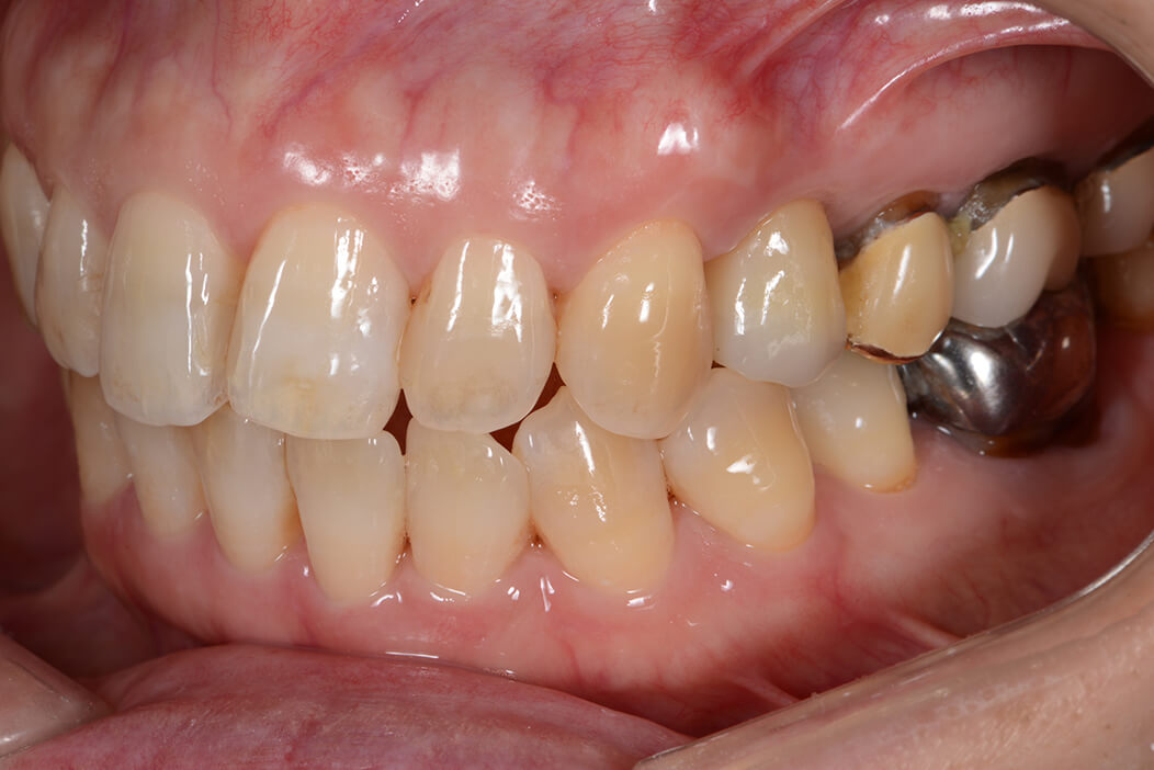 上顎左側第一小臼歯にフラップレスインプラント手術で即時修復治療を行なった症例
