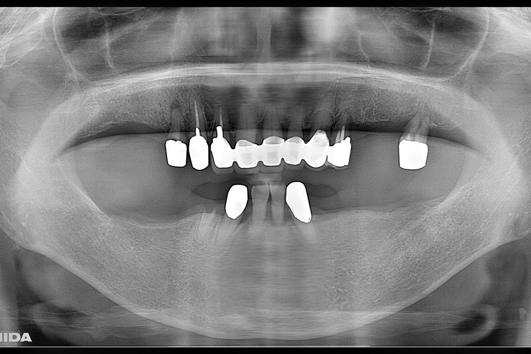 下顎に4本のインプラントを使って固定式ブリッジを行った（オールオンフォー）症例