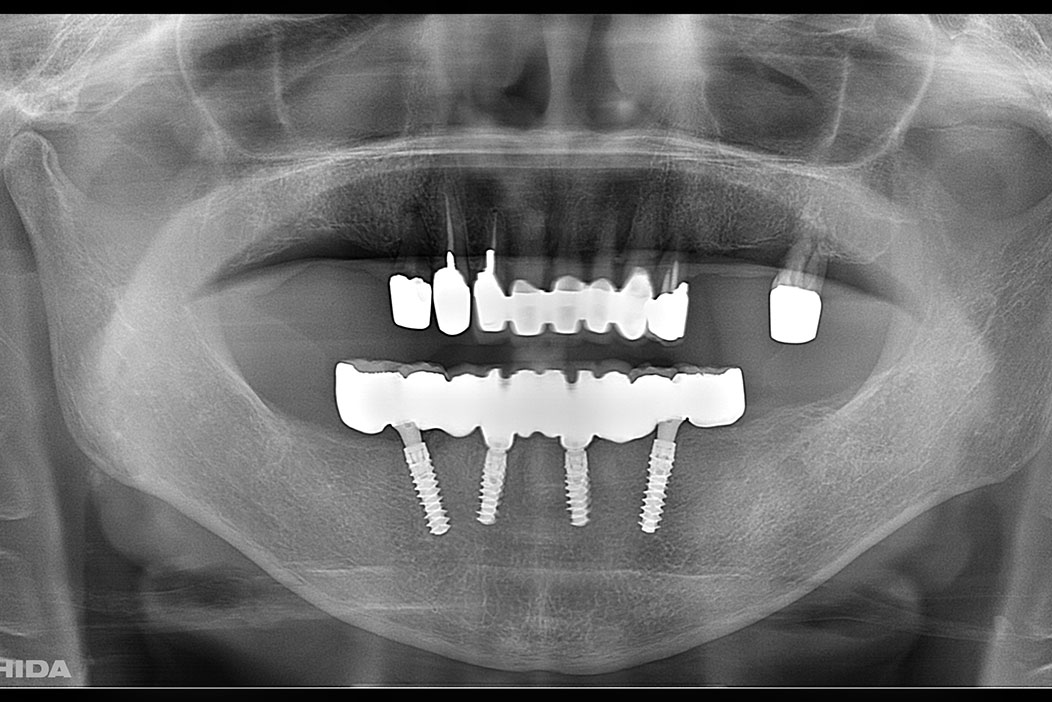 下顎に4本のインプラントを使って固定式ブリッジを行った（オールオンフォー）症例