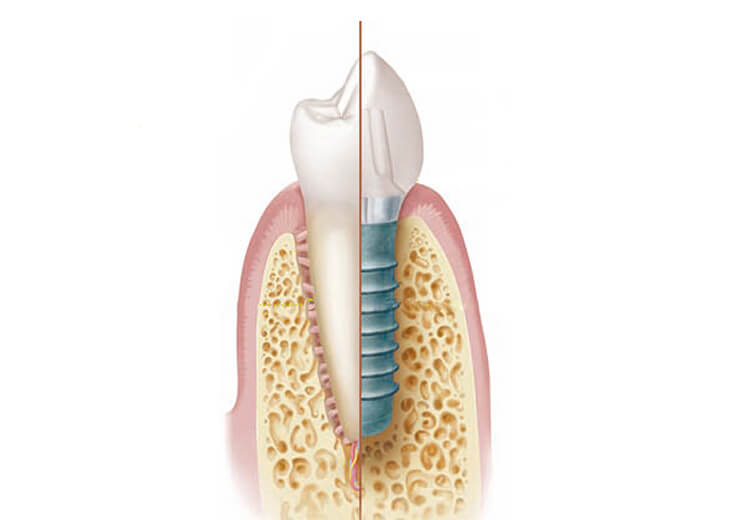 インプラントによる治療とは